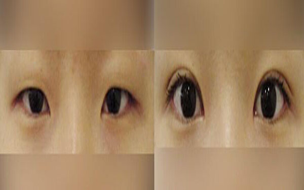 注射玻尿酸丰太阳穴安全吗