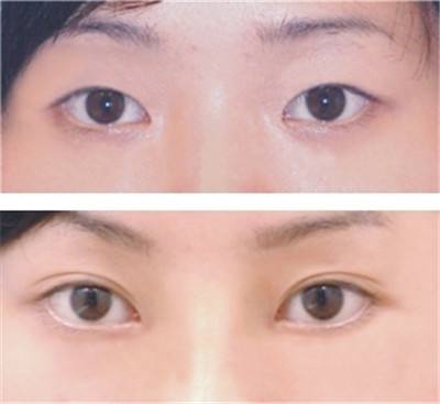 想问问激光美容术以后需要注意什么