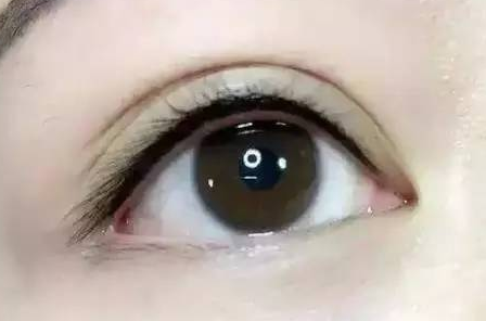 韩式开眼角手术缺点有哪些