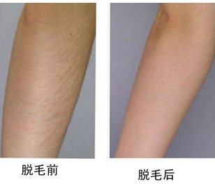 自体脂肪去法令纹多久可以做表情