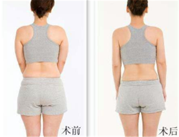 乳房整形后都需要注意什么
