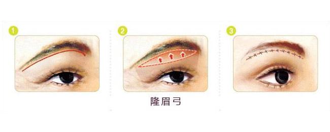 昆明哪些美容机构可以做络腮胡脱毛?