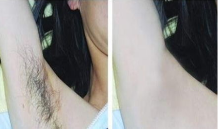腹部抽脂会有后遗症吗