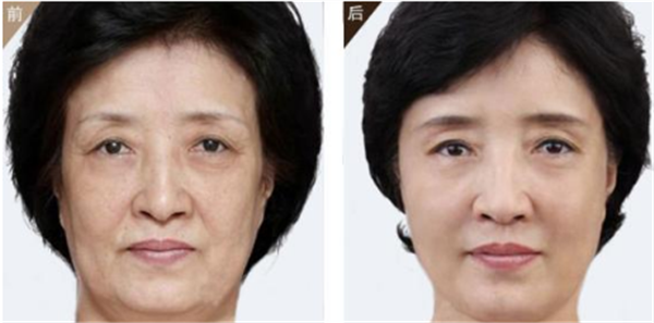 有没有什么方法可以去黑眼圈啊