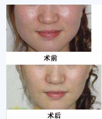 半永久纹绣和水光补水区别