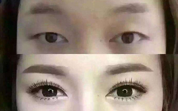 缝完针脸上有疤怎么办