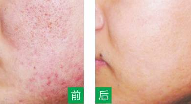 玻尿酸丰唇珠安全性是绝对的吗?