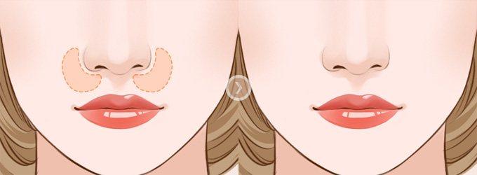 乳房整形术后要有哪些注意