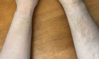 做鼻小柱延长要多少钱呢?