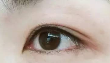 膨体隆鼻手术效果如何