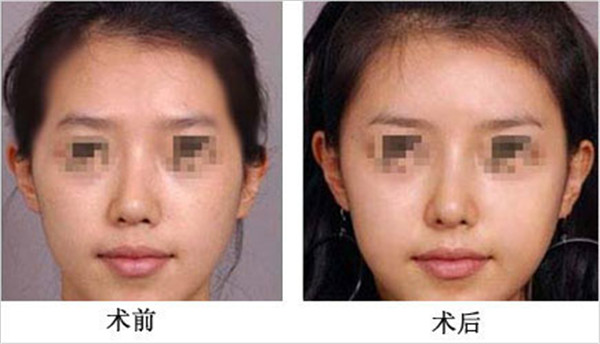 鼻骨矫正手术多少钱?