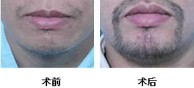 自体脂肪填充额头后疼几天?
