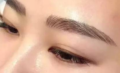 怎样去红血丝的方法