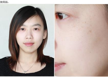 激光脱络腮胡后还会越刮越多吗