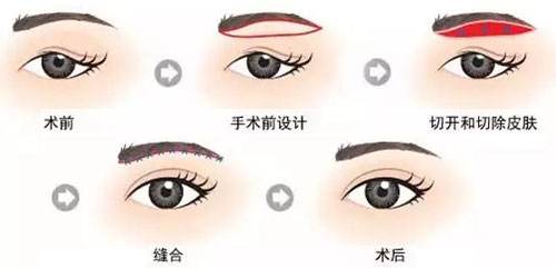 要怎样去鱼尾纹最有效?