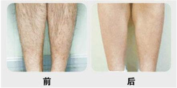 眼睑矫正手术恢复时间