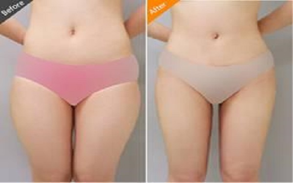 乳房整形之后在饮食上注意些什么啊