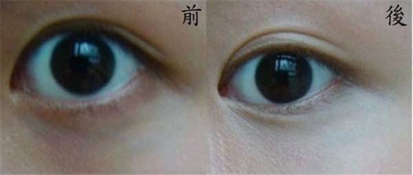 垫鼻子的费用一般是多少