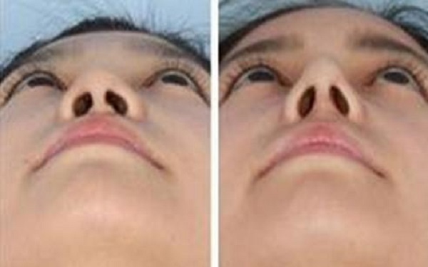 韩式三点式双眼皮恢复时间