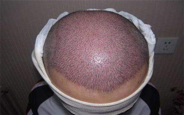 瓷贴面能保持多久