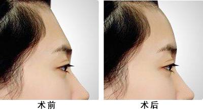 下眼线有痣去除会危害眼睛吗