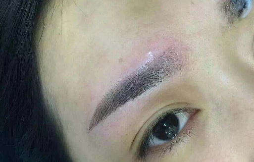 微笑唇整形价钱