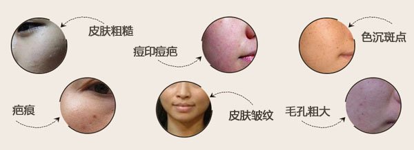 络腮胡整形副作用有哪些