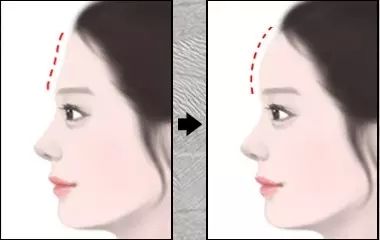 什么时候做上睑下垂矫正合适
