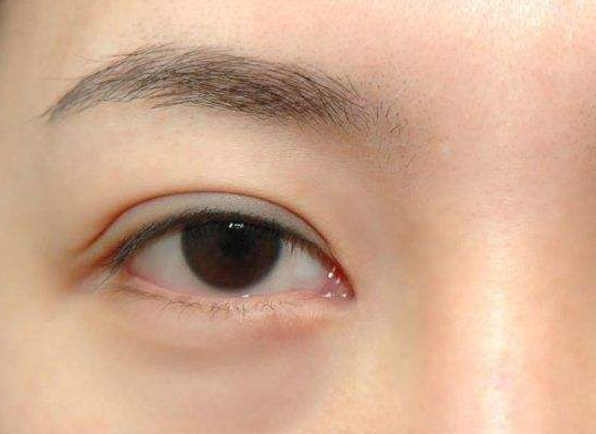 下垂眼睑矫正多少钱