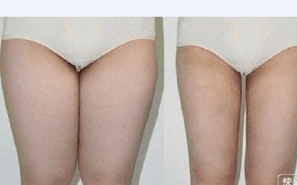 腰腹部抽脂要多少钱