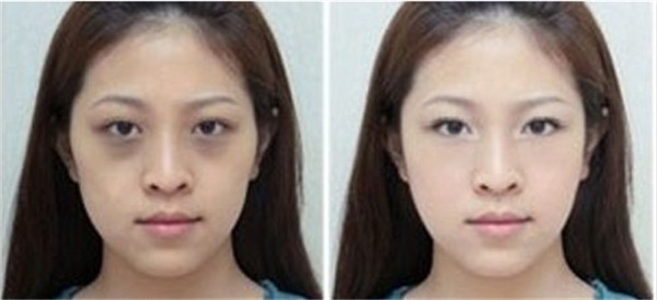 打激光后会留疤痕吗