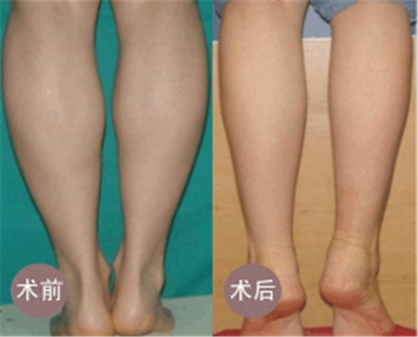 颞部除皱去鱼尾纹效果怎样呢?