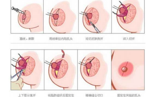 激光去雀斑手术之前哪些事项需要注意