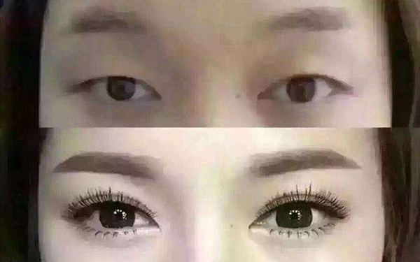 激光嫩肤美白要多少钱