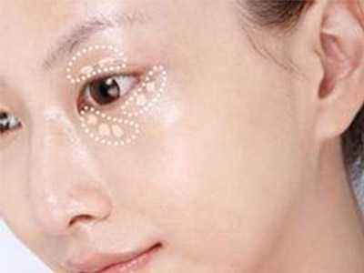 做完泪沟填充注意事项有什么?
