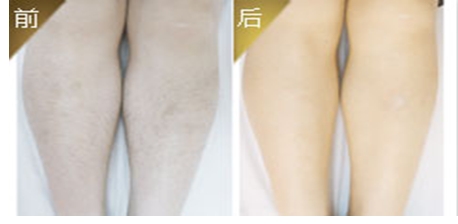 微笑唇整形多久恢复
