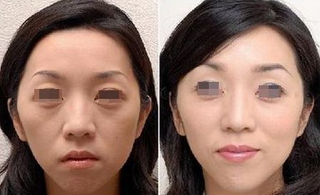 丰太阳穴用什么丰