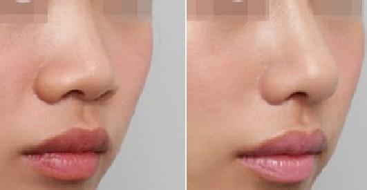 鼻部做鼻孔整形术后创伤恢复要多久?