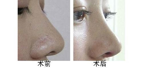 双眼皮微创割安全性高吗