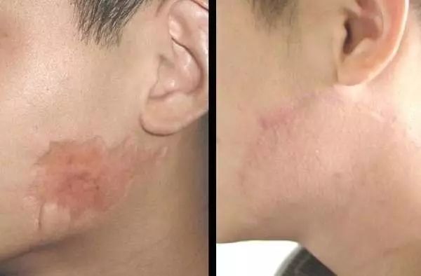 络腮胡脱毛价格?