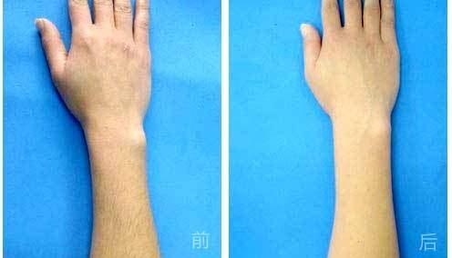 果酸换肤多少钱?果酸换肤能去痘坑吗