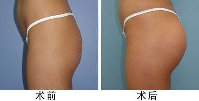 纹眉之后眼睛肿了怎么办