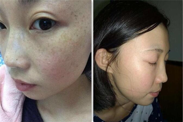 剖腹产疤痕修复的注意什么