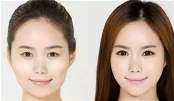 光子嫩肤美白的效果好么