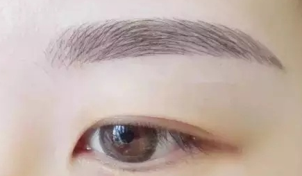厚唇变薄术后的恢复时间是多久？
