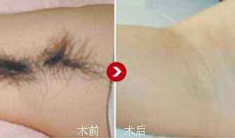 激光祛疤后多久能碰水