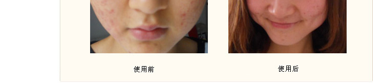 腿部抽脂容易反弹吗