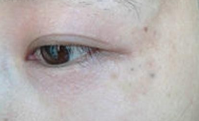 光子嫩肤美白要多少钱