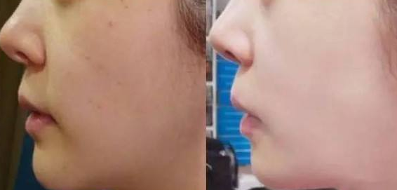 眼部修复术费用多少