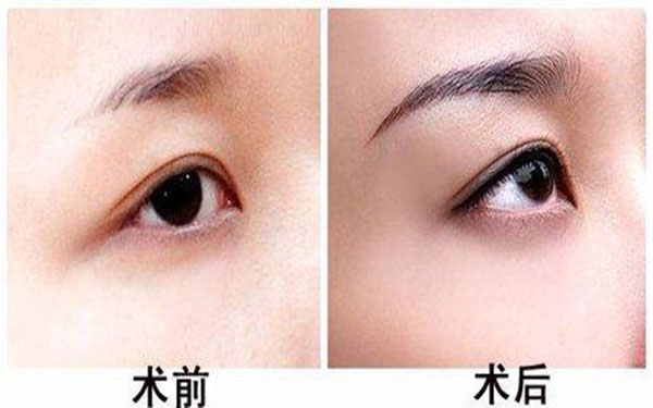 鼻部鼻小柱延长方法有哪些？